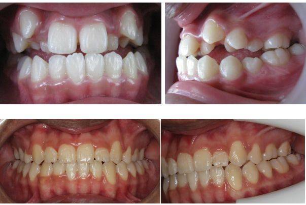 哪些牙颌畸形需要拔牙矫正