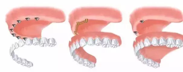 全口义齿修复后有哪些常见问题