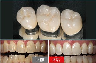 做烤瓷牙有年龄限制吗 做烤瓷牙一般需要就诊几次