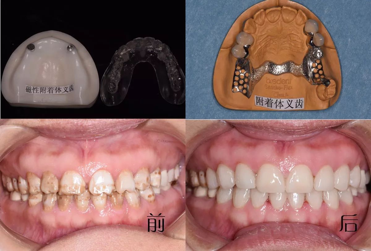 磁性附着体假牙对人体有害吗