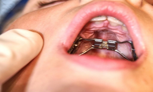 儿童牙齿矫正的矫正器有哪些
