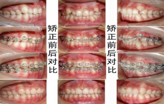 牙齿矫正都要经历怎样的过程
