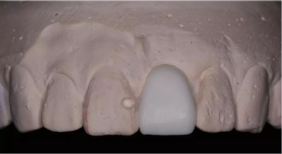 取印模常用的是什么材料 有毒吗