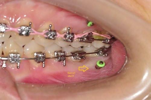 控制支抗在正畸治疗中有什么意义 加强支抗的方法有哪些