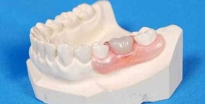 镶牙前要做哪些准备工作