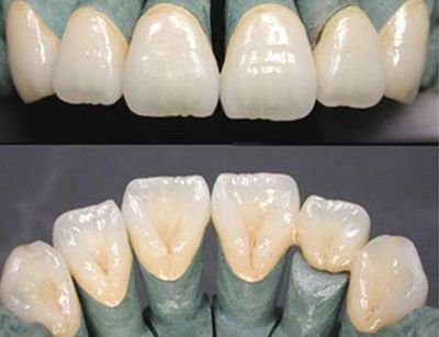 什么是烤瓷修复正畸 烤瓷修正正畸有哪些治疗要点