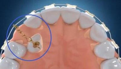 埋伏牙如何进行正畸治疗 多生牙如何进行正畸治疗