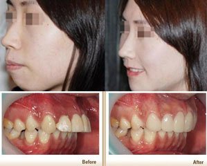 “龅牙”是什么原因造成的 龅牙可以通过正畸变美观吗