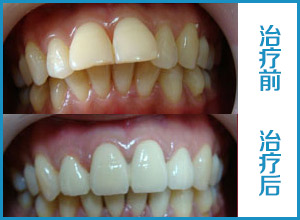 “龅牙”矫治什么年龄最佳