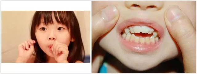 吮指习惯有哪些危害 吮指如何预防及矫治