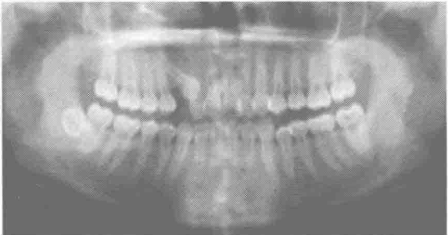 矫正牙齿为什么要拍X线片取模型 有些正畸前为什么要做CT检查
