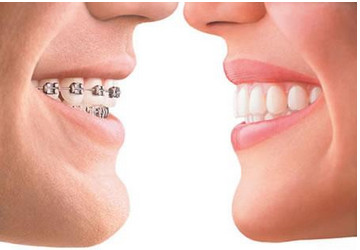 什么是隐形矫正 隐形矫正与传统矫治有什么不同