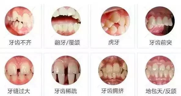 为什么会发生牙颌畸形