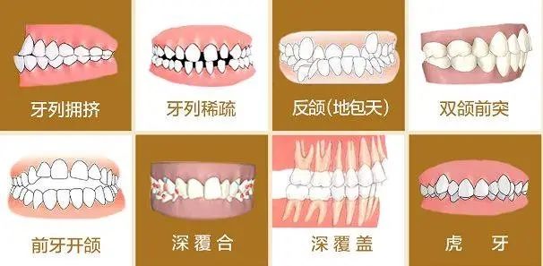 牙颌畸形有哪些主要的危害