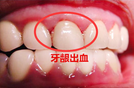 牙龈出血是怎么回事