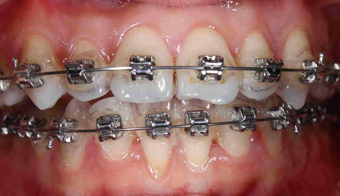 牙齿需要保持多长时间 戴用保持器的注意事项