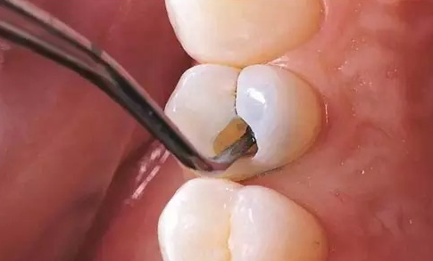 什么叫根管治疗 根管治疗的过程是什么样的