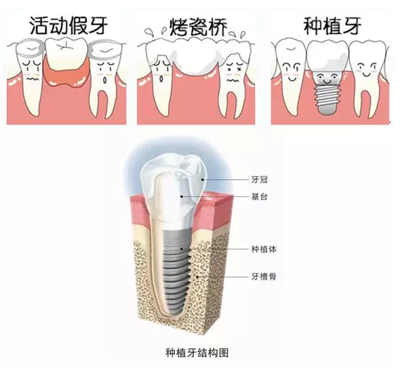 种植牙的治疗方法是什么 种植牙的治疗过程是什么