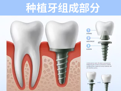 缺牙的修复方式有什么区别