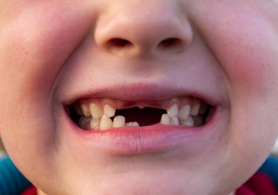 缺牙对咬合系统的影响