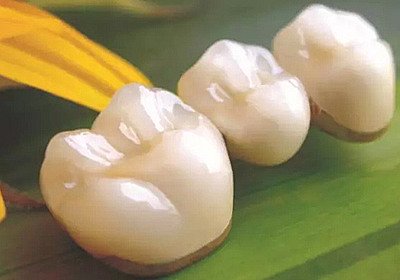 烤瓷牙、贴面、全瓷冠有什么区别 做烤瓷冠需要多长时间