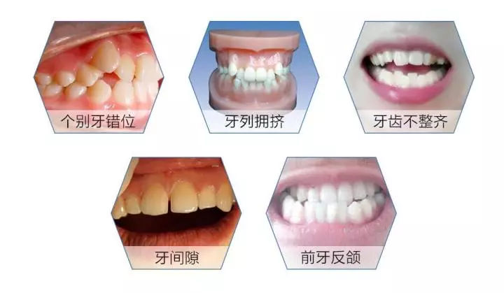 错颌畸形对口腔有什么影响 错颌畸形对患者心理有什么影响