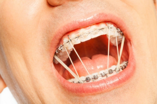 正畸治疗中牙周病该如何处理