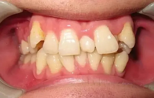 错颌畸形的发生率是多少 错颌畸形的临床表现是什么