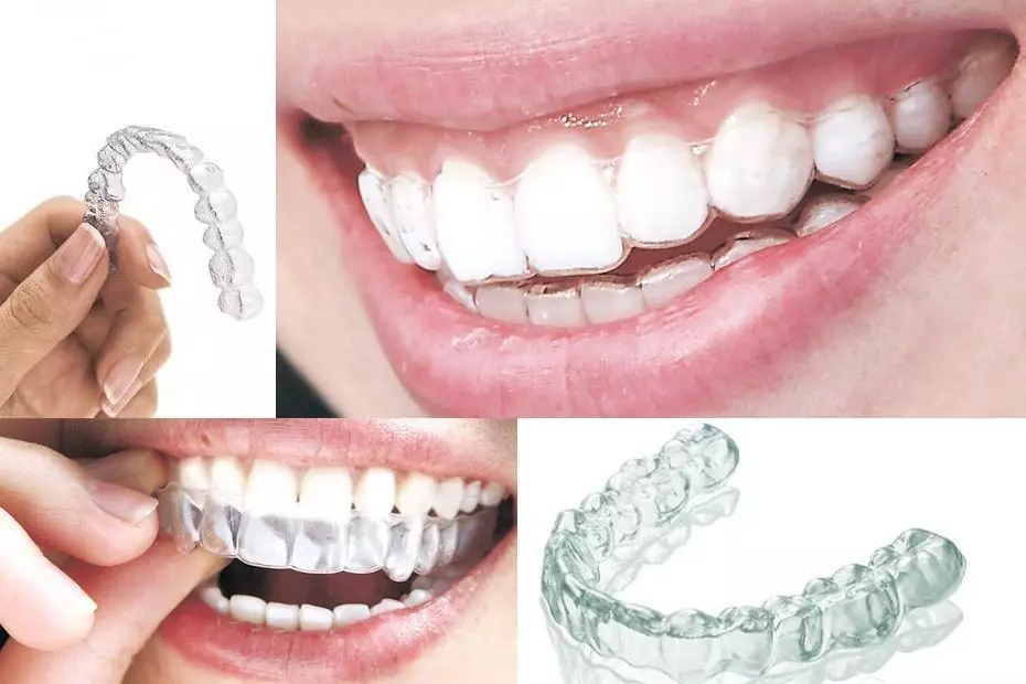 无托槽隐形矫治有什么优点