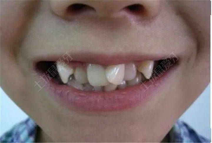 牙齿拥挤的原因是什么 牙齿拥挤的临床表现是什么
