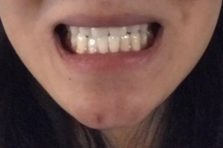 引起前牙反颌的因素有哪些