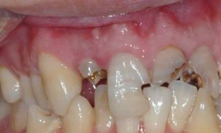 牙齿疾病和全身健康有关系吗