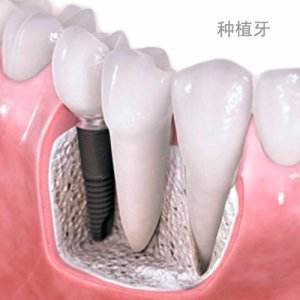 早期种植是什么 早期种植有什么适应证和禁忌证