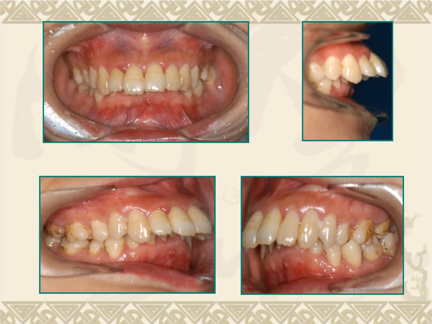 引起前牙深覆盖的因素是什么