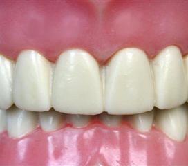 前牙深覆盖的临床表现是什么样的