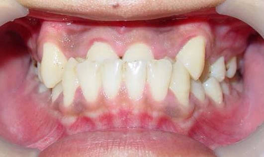 后牙反颌的原因是什么 后牙反颌的临床表现是什么