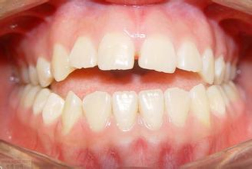开颌的原因是什么 开颌的临床表现是什么