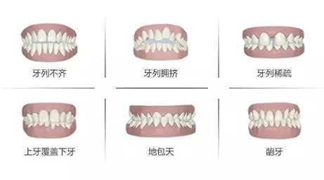 错颌矫治后保持的种类有哪些