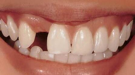 前牙缺失有什么特征 前牙修复的治疗原则是什么