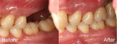 后牙牙缺失的特征是什么 后牙修复的治疗原则是什么