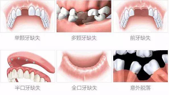 全口牙缺失的特征是什么 全口牙修复的治疗原则是什么
