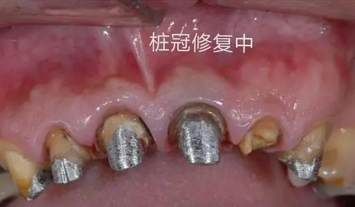 桩冠是什么 桩冠怎样做