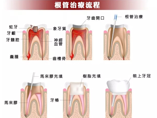 什么是根管治疗 根管治疗怎么进行