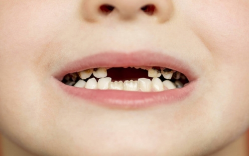 儿童牙齿缺失应该镶牙吗 牙齿缺失的修复方法是什么