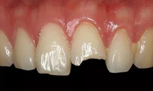 牙体缺损是什么 牙体缺损的临床表现是什么