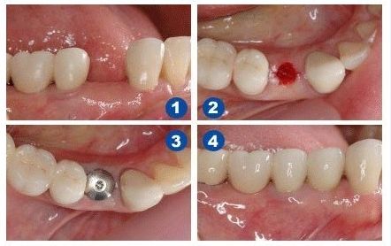 颌面部结构与种植牙治疗相关吗