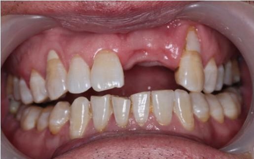 牙缺失的常见原因有什么 不同位置的牙缺失怎么选择种植体