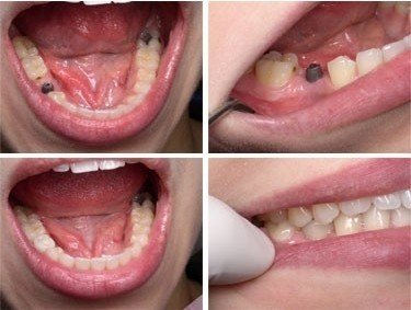 牙缺失的数量对种植体的选择有影响吗