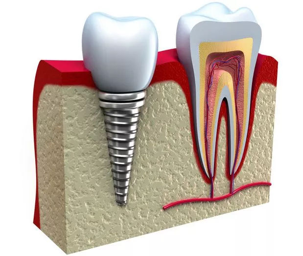 什么是种植牙的稳定性
