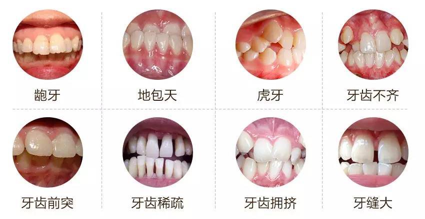 牙颌畸形的矫治目标是什么 牙颌畸形的矫治标准是什么